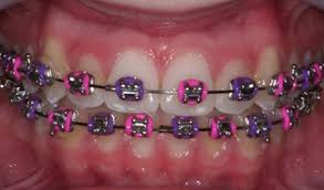 Purple Braces Look Braces Colors Braces Teeth Colors Cute Braces