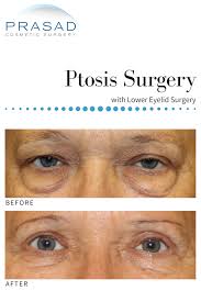 Eyelid Ptosis Surgery Eyelid Surgery Eye Lift Surgery Facial Surgery