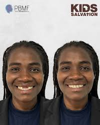 É emocionante de ver o dom que a prótese bucomaxilofacial tem de mudar as  vidas dos pacientes que necessitam de reabilitação Prótese Nasal feita  pelas alunas Laura Prato e Monique Blank orientado