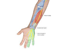 Neuropatia Del Nervio Cubital Causas Sintomas Y Tratamiento