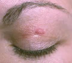 skin from upper eyelid was taken to create a graft to fill in missing skin for the lower lid. What Explains This Tender Pruritic Patchy Rash Consultant360