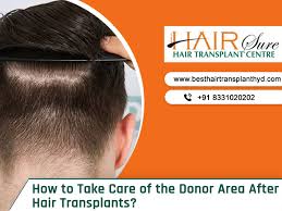 Summer hair care tips will help you give beautify and attractive hair quality. How To Take Care Of The Donor Area After Hair Transplants Cyber Hairsure
