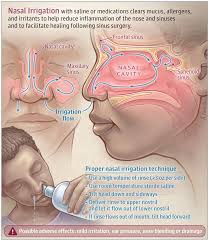 Saline Irrigation And Topical Nasal Steroids Medical Knowledge Sinus Surgery Human Anatomy And Physiology