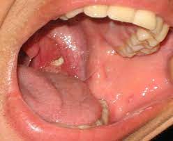 Apple cider vinegar can help flush the stones out, while changing the ph of the throat to help prevent infections. What Are Tonsil Stones And How Do You Get Rid Of Them