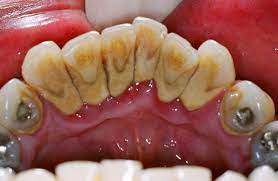 What Is Periodontal Gum Disease