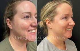 Neurotoxins Near Valrico