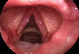Image result for Reflux Laryngitis