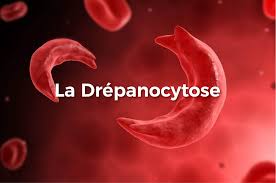 Drépanocytose solution naturelle
