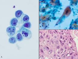 Merkel cell carcinoma is a rare type of skin cancer that usually starts in areas of skin exposed to the sun. A Practical Guide For Ancillary Studies In Pulmonary Cytologic Specimens Auger 2018 Cancer Cytopathology Wiley Online Library