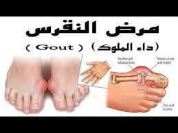 مرض النقرس اعراض مرض النقرس كارز