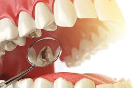 Resultado de imagen de &iquest;C&oacute;mo evitar las caries?