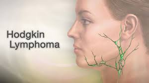Image result for Lymphoma