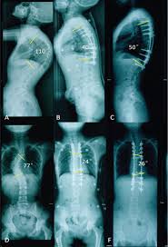The mating posture displayed by female rodents and certain other. Scielo Brasil Posterior Only Spinal Fusion Without Rib Head Resection For Treating Type I Neurofibromatosis With Intra Canal Rib Head Dislocation Posterior Only Spinal Fusion Without Rib Head Resection For Treating Type I