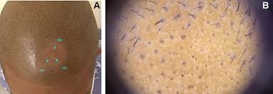 Do not use hair styling products and tools as they can cause further damage. Management Of Lupus Erythematosus Alopecia Ccid