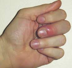 Nagelbettentzundung Nd24