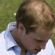 It usually occurs gradually and in predictable patterns — a receding hairline and bald spots in men and thinning hair along the crown of the scalp in women. Wigs For Male Pattern Baldness In Leeds Morelywigs Hair Pieces Leeds Morley