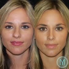Cirugia Plastica Plastic Surgery Gary Motykie Md Facs On Instagram Rhinoplasty This 28 Year Old Twin Underw In 2020 Rhinoplasty Nose Surgery Nose Reshaping
