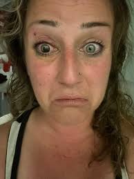 Is that a ripped eye lid?