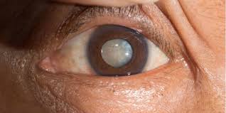 You'll probably have another ophthalmologist appointment around that time. What Are Cataracts American Academy Of Ophthalmology