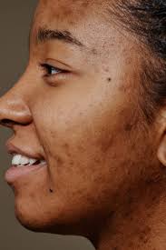 We're told we need to 'fix' our skin. What if we said no?