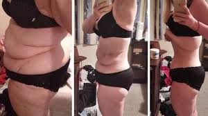 Pin On Weight Loss Surgery