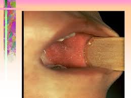 In adults, lesions occur on the trunk. Measles Definition Measles Is An Acute Highly Contagious