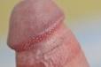Des petits bouton sous la base du gland du pnis. - Infections