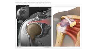 Simple easy notes for quick revision for thickening or calcium deposits in the supraspinatus tendon or subacromial bursitis results in pain during abduction of shoulder joint from 60° to 120°. Anterior Supraspinatus Tendon Tear High Impact Visual Litigation Strategies