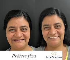 🦷 Do desconforto à confiança total! Confira o resultado de uma  reabilitação com próteses fixas de porcelana que devolveu ao nosso paciente  a estética, a mastigação e, o mais importante, a autoestima!