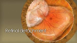 Image result for Retinal Detachment