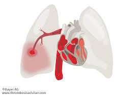 El principal factor de riesgo para la aparición de un evento tromboembólico. Que Es Y Causas Del Tromboembolismo Pulmonar Causas Trombosis Pulmonar