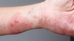 Image result for scabies symptoms