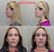 Does blue shield cover jaw surgery. Physiologic Orthodontics Non Surgical Jaw Treatment Smile Doctor Randi Green Dmd Lvif