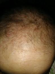 We did not find results for: My Baby Is Having Red Rashes On His Head And On His Face I M Concerned That Are