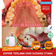 Oleh karena itu, tampaknya obat yang satu ini memang harus selalu anda. Obat Herbal Penghancur Gigi Berlubang Obat Tetes Herbal Alami Propolis Sm Asli 100 Original Shopee Indonesia
