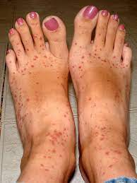 Inspiration Creativity Wonder Food Allergy Rash Skin Allergy Allergies