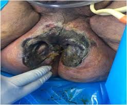 Feb 18, 2019 · if fournier's gangrene is suspected, stop the sglt2 inhibitor and start treatment urgently (including antibiotics and surgical debridement). Fournier S Gangrene As A Rare Complication In Patient With Uncontrolled Type 2 Diabetes Treated With Surgical Debridement A Case Report And Literature Review Sciencedirect