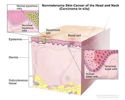 You may be in remission and yet not be cancer. Skin Cancer Types Symptoms Information Dana Farber Cancer Institute Boston Ma
