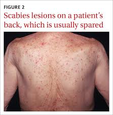 Image result for scabies human bites