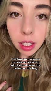 Discover How Ocean Remedies Helped My Eczema