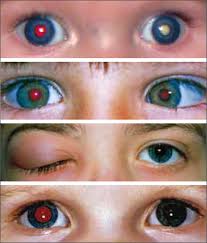 Image result for Red Reflex