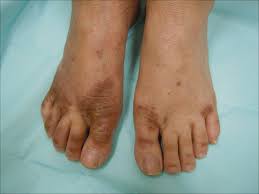Image result for Onychotillomania feet