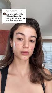 Replying to @(^з^)-☆ liv ☆〜（ゝ。∂） thank you for sharing what helped you 🫶🏼  I love knowing there is light at the end of this tunnel ❤️ #acnejourney🥺  #acneupdate