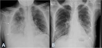 There is a layering pleural eﬀusions. Chest X Ray Findings Monitoring Covid 19 Disease Course And Severity Egyptian Journal Of Radiology And Nuclear Medicine Full Text