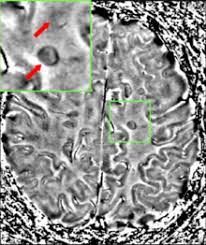 Teste pentru confirmarea diagnosticului de scleroză multiplă. SclerozÄƒ MultiplÄƒ Wikipedia