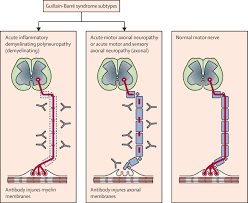 Weakness and tingling in your extremities are usually the first symptoms. Guillain Barre Syndrome The Lancet