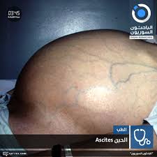 الباحثون السوريون الحبن Ascites إستسقاء البطن