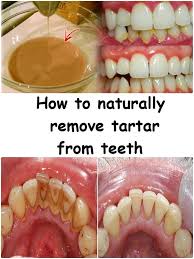How to clean plaque off teeth with braces. How To Remove Braces At Home Arxiusarquitectura