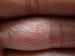 Image result for pompholyx soles of feet