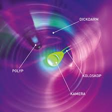 Wenn die blutung stark ist, z.b. Polypentfernung Darmkrebs De